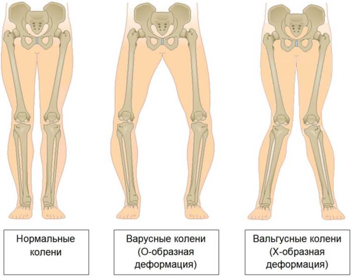 Варусная и вальгусная деформации коленных суставов